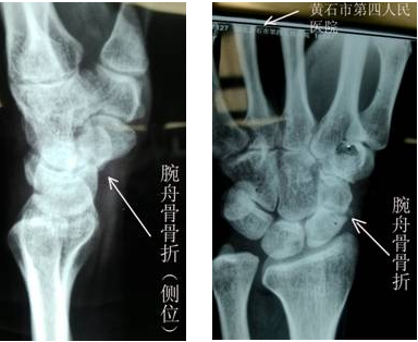 微创经皮空心钉内固定治疗腕舟骨骨折 黄石市第四医院